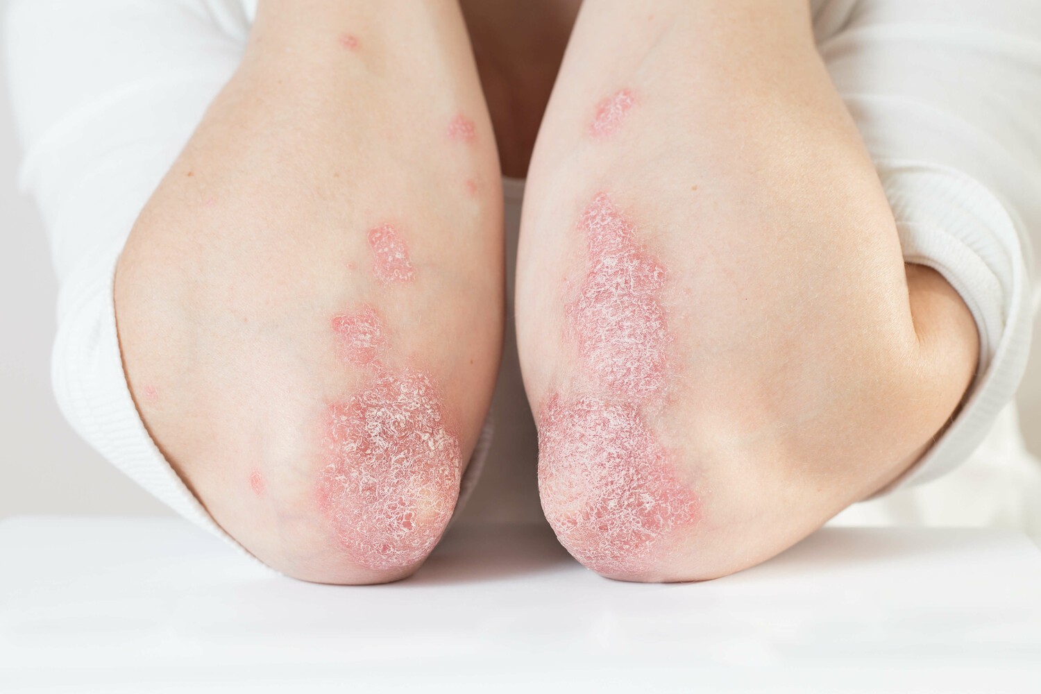 Wat is psoriasis?